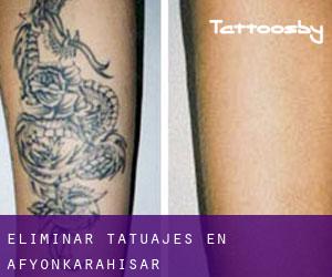 Eliminar tatuajes en Afyonkarahisar