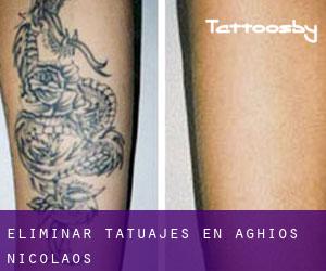 Eliminar tatuajes en Aghios Nicolaos