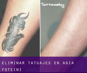 Eliminar tatuajes en Agía Foteiní