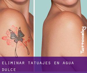Eliminar tatuajes en Agua Dulce