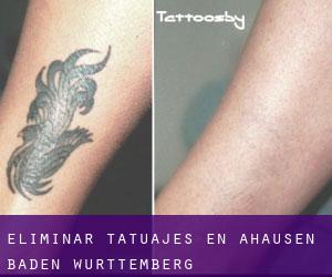 Eliminar tatuajes en Ahausen (Baden-Württemberg)