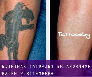 Eliminar tatuajes en Ahornhof (Baden-Württemberg)