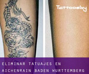 Eliminar tatuajes en Aichenrain (Baden-Württemberg)