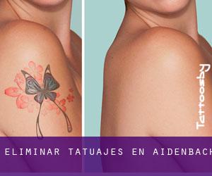 Eliminar tatuajes en Aidenbach
