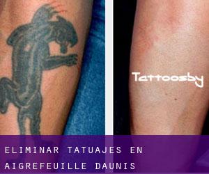 Eliminar tatuajes en Aigrefeuille-d'Aunis
