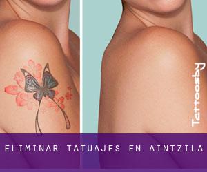 Eliminar tatuajes en Aintzila