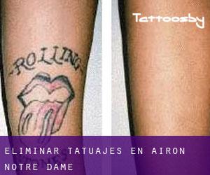 Eliminar tatuajes en Airon-Notre-Dame