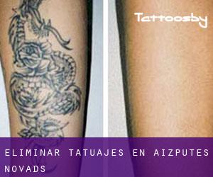 Eliminar tatuajes en Aizputes Novads