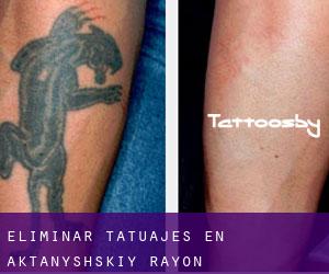 Eliminar tatuajes en Aktanyshskiy Rayon