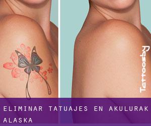 Eliminar tatuajes en Akulurak (Alaska)