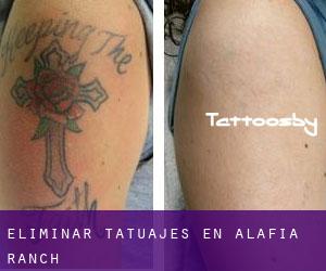 Eliminar tatuajes en Alafia Ranch