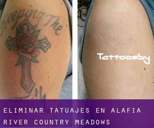 Eliminar tatuajes en Alafia River Country Meadows