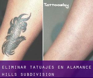 Eliminar tatuajes en Alamance Hills Subdivision