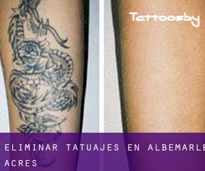 Eliminar tatuajes en Albemarle Acres