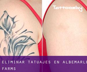 Eliminar tatuajes en Albemarle Farms