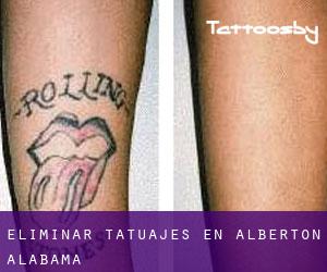 Eliminar tatuajes en Alberton (Alabama)