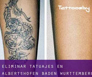 Eliminar tatuajes en Albertshofen (Baden-Württemberg)