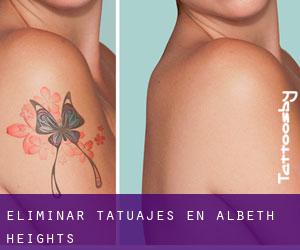 Eliminar tatuajes en Albeth Heights