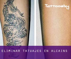 Eliminar tatuajes en Alcains