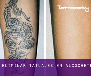 Eliminar tatuajes en Alcochete