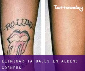 Eliminar tatuajes en Aldens Corners