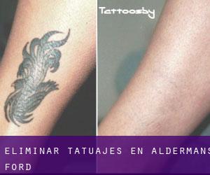 Eliminar tatuajes en Aldermans Ford