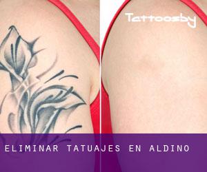 Eliminar tatuajes en Aldino