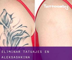 Eliminar tatuajes en Aleksashkina