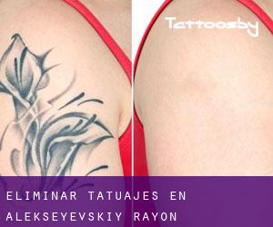 Eliminar tatuajes en Alekseyevskiy Rayon
