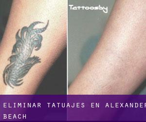 Eliminar tatuajes en Alexander Beach