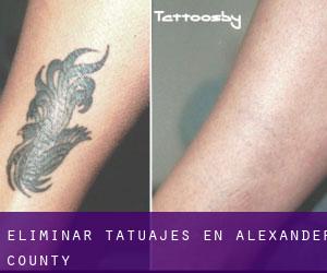 Eliminar tatuajes en Alexander County