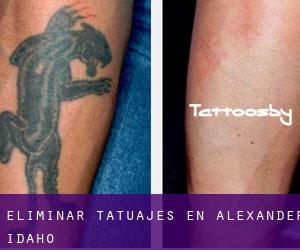 Eliminar tatuajes en Alexander (Idaho)