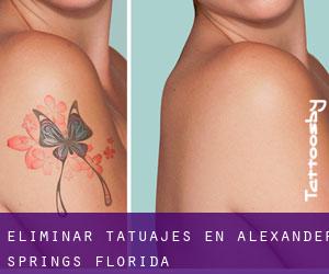 Eliminar tatuajes en Alexander Springs (Florida)