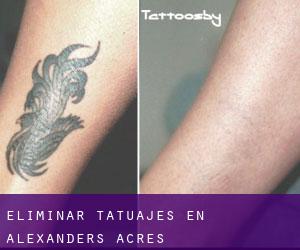 Eliminar tatuajes en Alexanders Acres