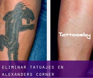 Eliminar tatuajes en Alexanders Corner