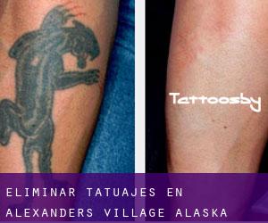 Eliminar tatuajes en Alexanders Village (Alaska)