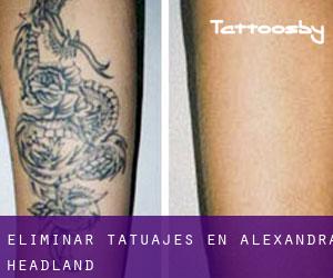 Eliminar tatuajes en Alexandra Headland