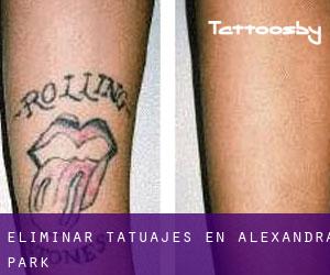 Eliminar tatuajes en Alexandra Park
