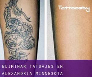 Eliminar tatuajes en Alexandria (Minnesota)
