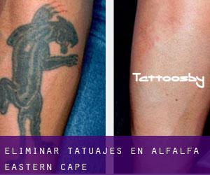Eliminar tatuajes en Alfalfa (Eastern Cape)