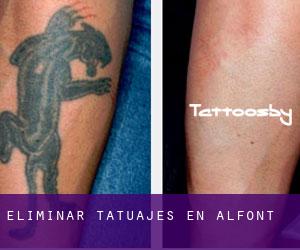 Eliminar tatuajes en Alfont