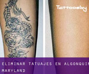 Eliminar tatuajes en Algonquin (Maryland)