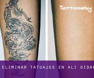 Eliminar tatuajes en Ali Oidak