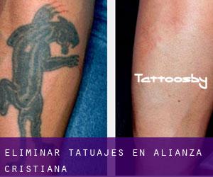 Eliminar tatuajes en Alianza Cristiana