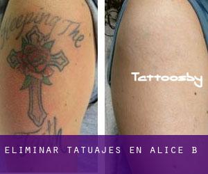 Eliminar tatuajes en Alice B