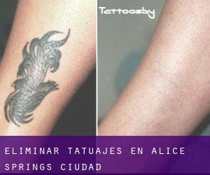 Eliminar tatuajes en Alice Springs (Ciudad)