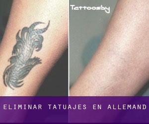 Eliminar tatuajes en Allemand