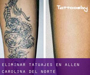 Eliminar tatuajes en Allen (Carolina del Norte)