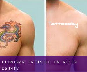 Eliminar tatuajes en Allen County