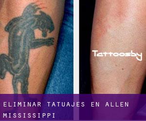 Eliminar tatuajes en Allen (Mississippi)